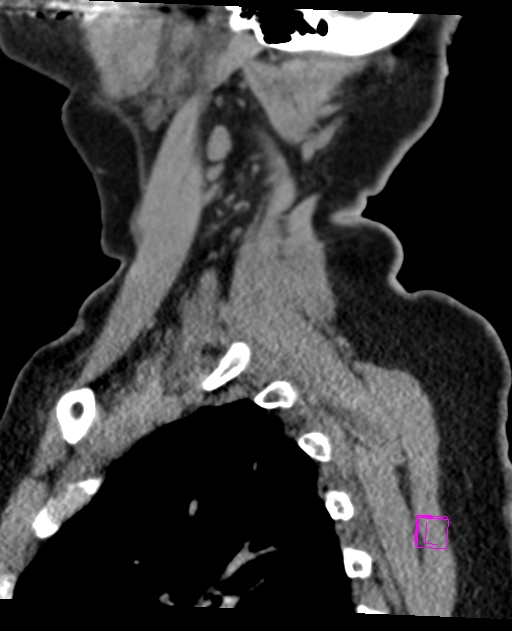 Bilateral atlanto-occipital assimilation (Radiopaedia 28350-28603 D 69).jpg