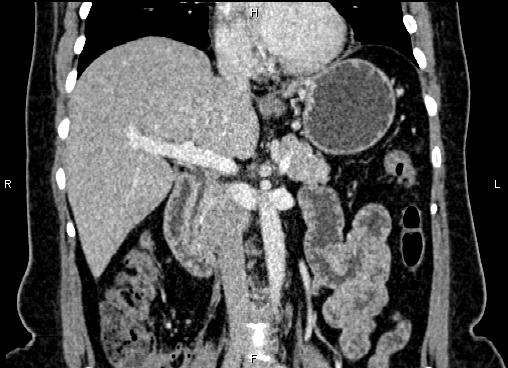 Bilateral benign adrenal adenomas (Radiopaedia 86912-103124 D 28).jpg