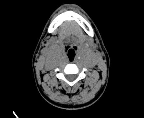 Bilateral carotid body tumors (Radiopaedia 61841-69870 Axial non-contrast 48).jpg