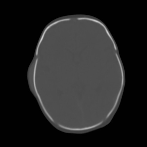 File:Bilateral cephalohematomas and subdural hematomas (Radiopaedia 26778-26929 Axial bone window 13).jpg