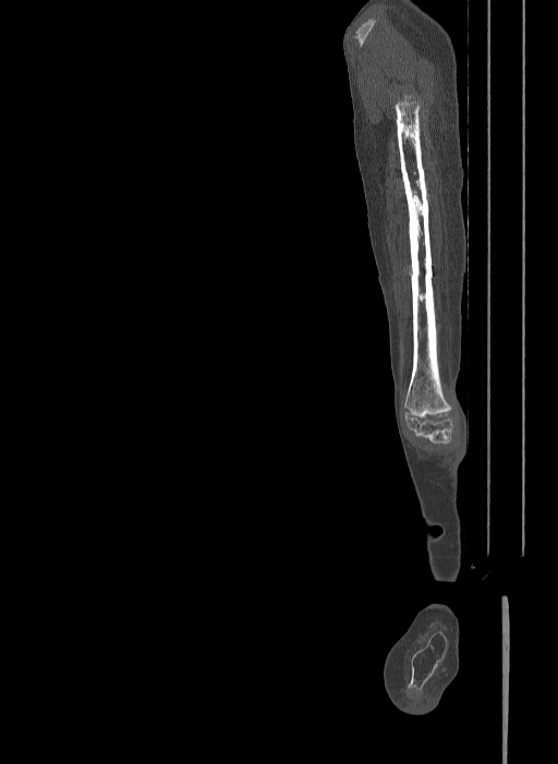 Bilateral fibular hemimelia type II (Radiopaedia 69581-79491 Sagittal bone window 22).jpg