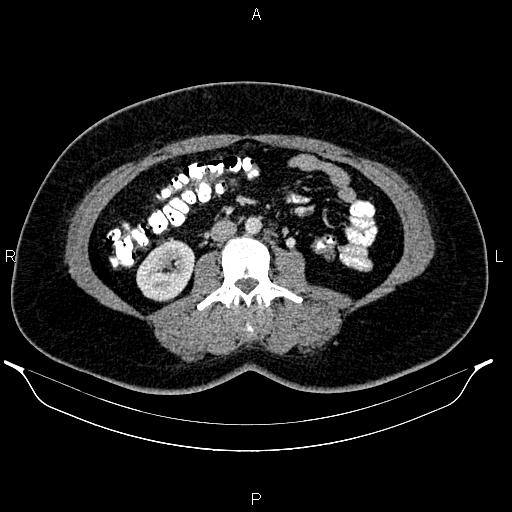 File:Bilateral ovarian dermoid cysts (Radiopaedia 85785-101603 A 56).jpg