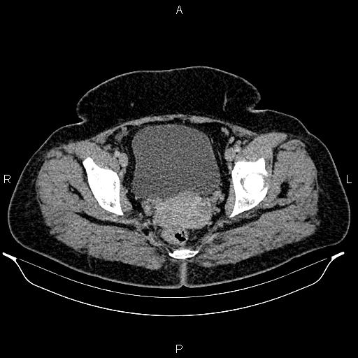 Bilateral ovarian dermoid cysts (Radiopaedia 85785-101603 A 98).jpg