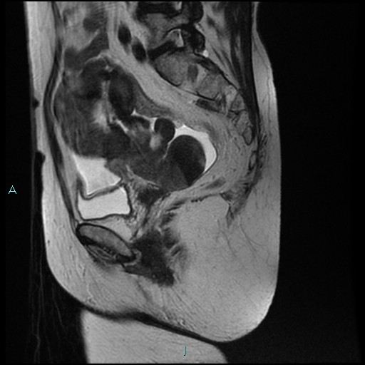 File:Bilateral ovarian fibroma (Radiopaedia 44568-48293 Sagittal T2 14).jpg