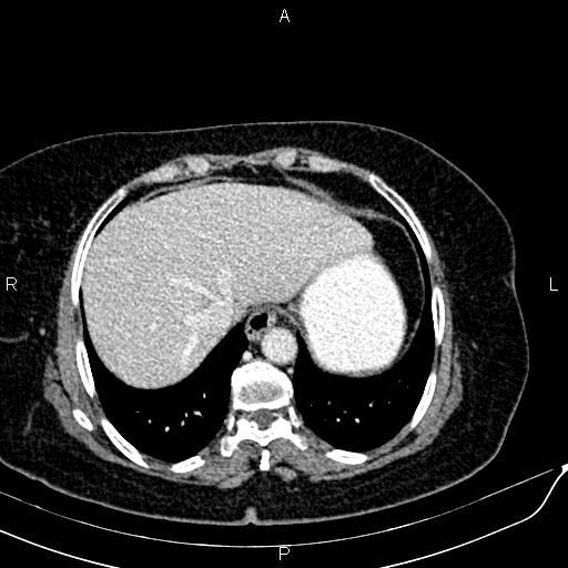 Bilateral ovarian serous cystadenocarcinoma (Radiopaedia 86062-101989 B 15).jpg