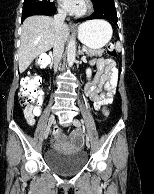 Bilateral ovarian serous cystadenocarcinoma (Radiopaedia 86062-101989 D 23).jpg