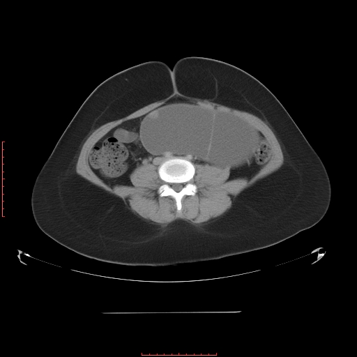 File:Bilateral ovarian serous cystadenocarcinoma with right ovarian torsion (Radiopaedia 32640-33611 A 26).jpg