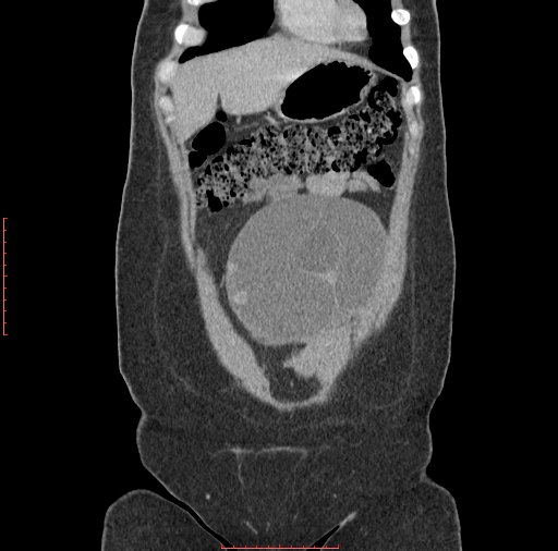 File:Bilateral ovarian serous cystadenocarcinoma with right ovarian torsion (Radiopaedia 32640-33611 B 5).jpg