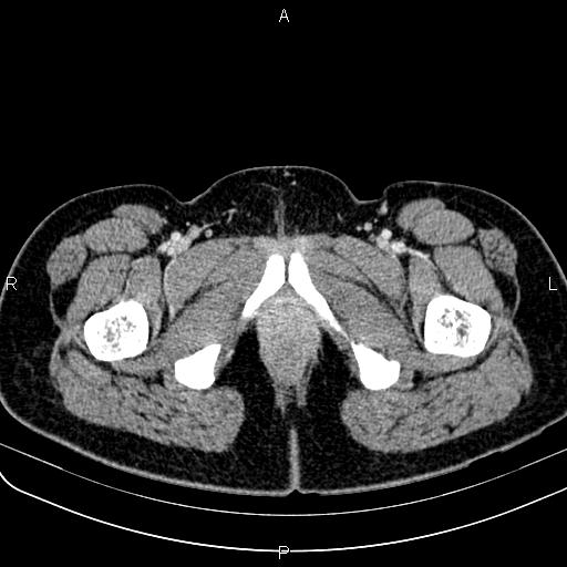 Bilateral ovarian teratoma (Radiopaedia 83131-97503 Axial With contrast 87).jpg