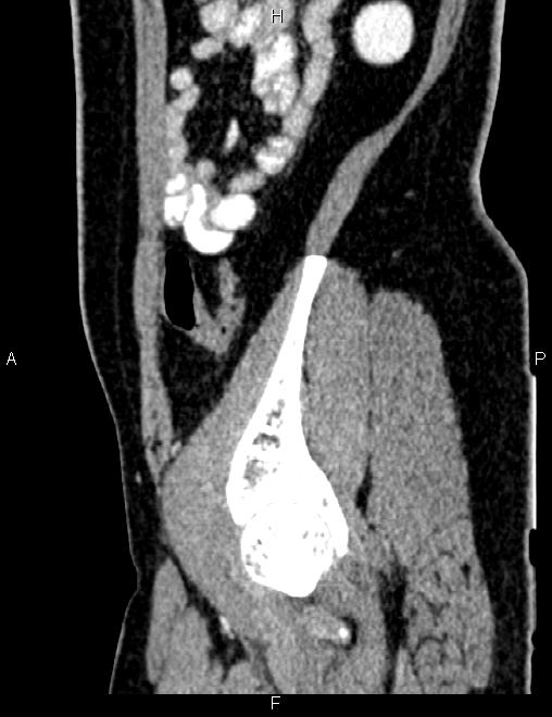Bilateral ovarian teratoma (Radiopaedia 83131-97503 D 90).jpg