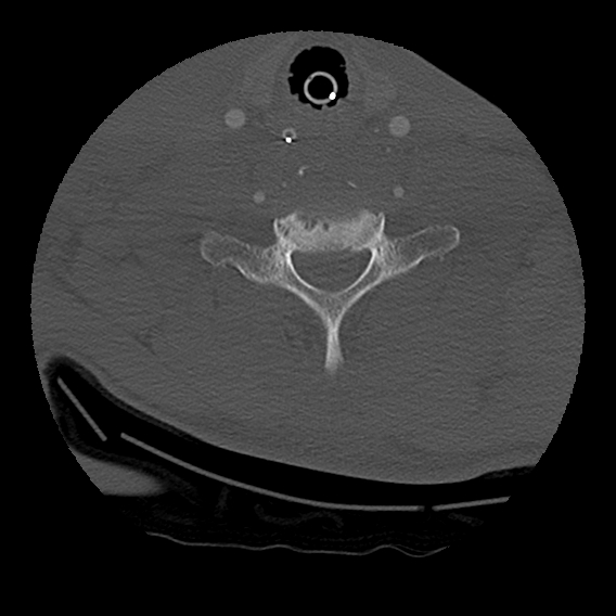 File:Bilateral perched facets with cord injury (Radiopaedia 45587-49713 Axial bone window 82).jpg