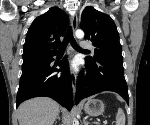 File:Bilateral pulmonary AVM (Radiopaedia 83134-97505 C 43).jpg
