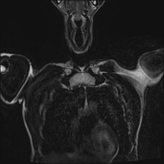 Bilateral spinoglenoid notch ganglion cysts (Radiopaedia 29577-30082 Coronal T2 20).jpg
