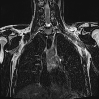 File:Bilateral spinoglenoid notch ganglion cysts (Radiopaedia 29577-30082 Coronal T2 59).jpg