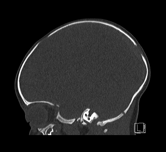 Bilateral subdural hemorrhage and parietal skull fracture (Radiopaedia 26058-26192 Sagittal bone window 32).png