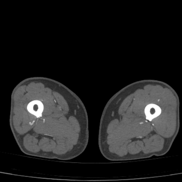 Bilateral superficial femoral arterial occlusion (Radiopaedia 25682-25857 A 42).jpg