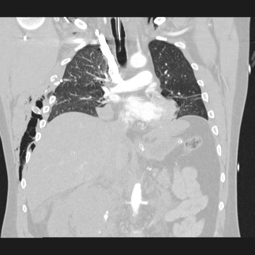 Bilateral traumatic renovascular injury (Radiopaedia 32051-32995 Coronal lung window 41).jpg