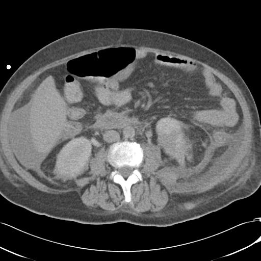 Bladder rupture post renal biopsy (Radiopaedia 30863-31572 Axial non-contrast 45).jpg