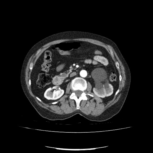 File:Bladder tumor detected on trauma CT (Radiopaedia 51809-57609 A 107).jpg