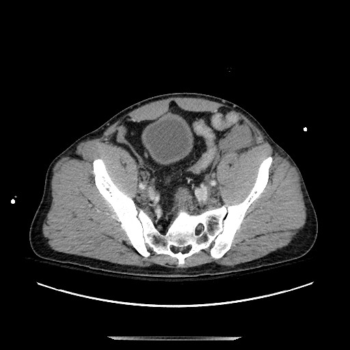 Blunt abdominal trauma with solid organ and musculoskelatal injury with active extravasation (Radiopaedia 68364-77895 A 125).jpg