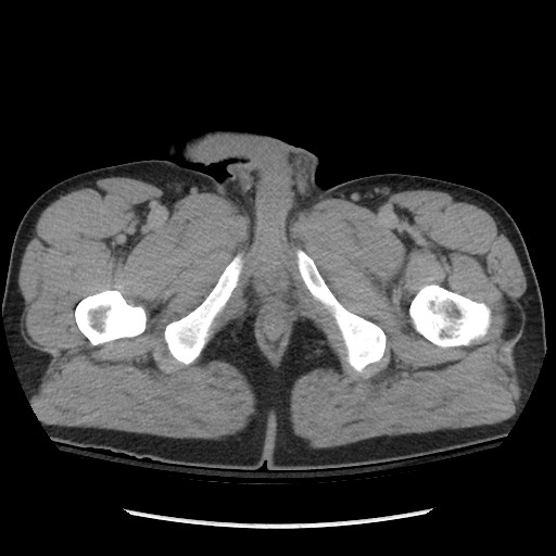 File:Blunt abdominal trauma with solid organ and musculoskelatal injury with active extravasation (Radiopaedia 68364-77895 Axial C+ delayed 149).jpg