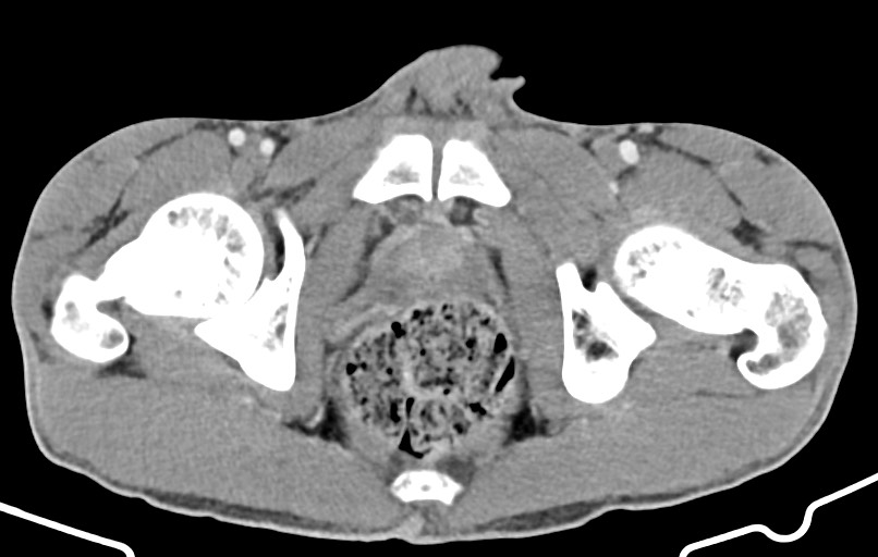 Blunt injury to the small bowel (Radiopaedia 74953-85987 A 192).jpg
