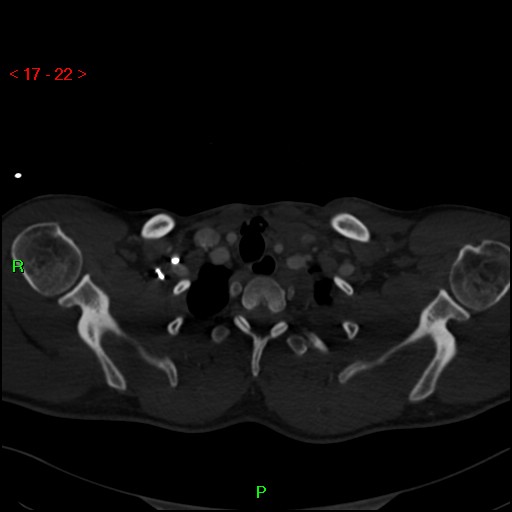 Blunt thoracic trauma (Radiopaedia 73454-84221 Axial bone window 9).jpg