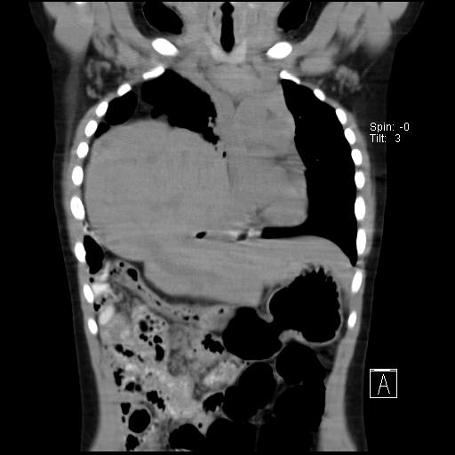 File:Bochdalek diaphragmatic hernia (Radiopaedia 38866-41059 Coronal liver window 9).jpg