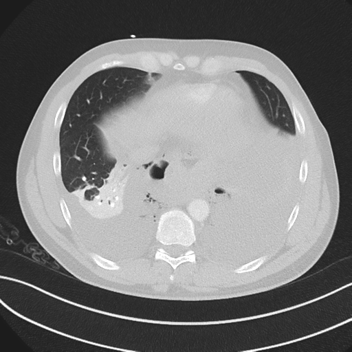 Boerhaave syndrome (Radiopaedia 39382-41660 Axial lung window 42).png