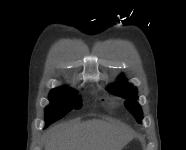 File:Boerhaave syndrome (Radiopaedia 39382-41660 C 15).png