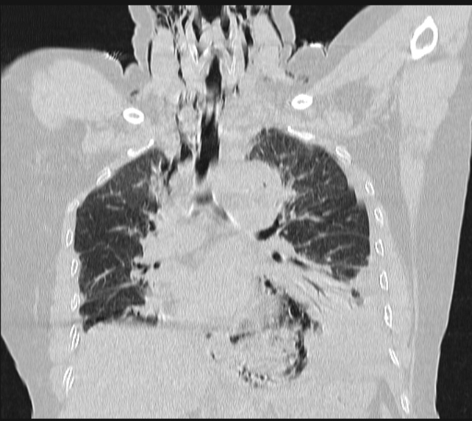 Boerhaave syndrome (Radiopaedia 45644-49799 Coronal lung window 35).jpg