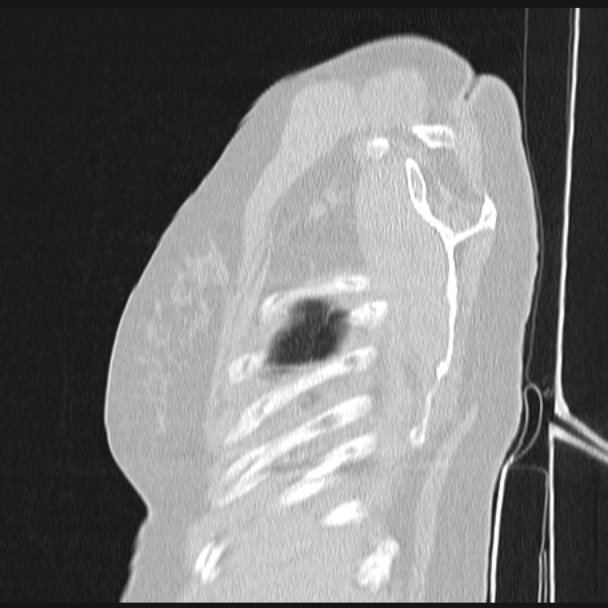 Boerhaave syndrome (Radiopaedia 45644-49799 Sagittal lung window 5).jpg