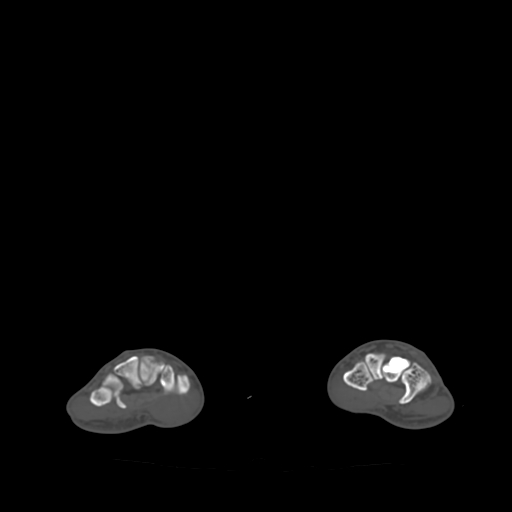 Bone islands - carpus (Radiopaedia 63141-71658 Axial bone window 31).jpg