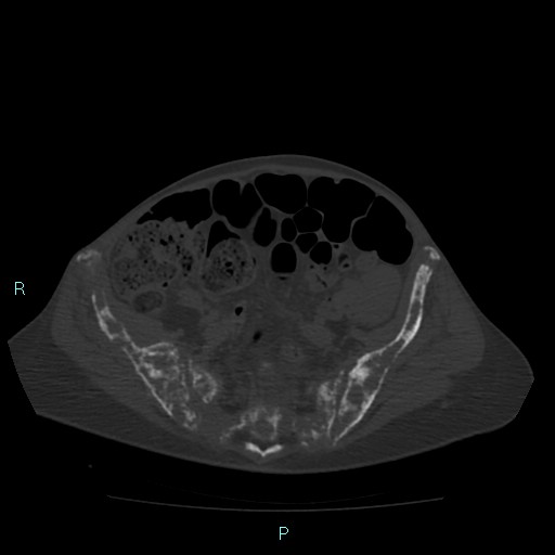 Bone metastases from untreated breast cancer (Radiopaedia 42973-46219 Axial bone window 156).jpg