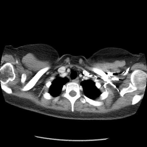 File:Borderline mucinous tumor (ovary) (Radiopaedia 78228-90808 A 6).jpg