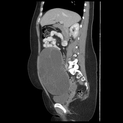File:Borderline mucinous tumor (ovary) (Radiopaedia 78228-90808 B 29).jpg