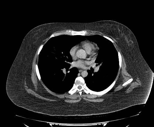 File:Bowel and splenic infarcts in acute lymphocytic leukemia (Radiopaedia 61055-68913 A 1).jpg