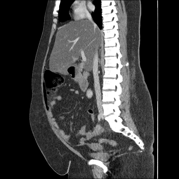 Bowel and splenic infarcts in acute lymphocytic leukemia (Radiopaedia 61055-68915 C 39).jpg