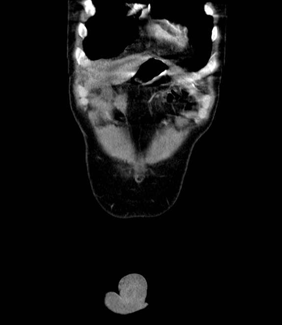 Bowel obstruction from colon carcinoma (Radiopaedia 22995-23028 C 6).jpg