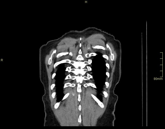 Brachial artery foreign body (Radiopaedia 54583-60820 Coronal non-contrast 56).jpg