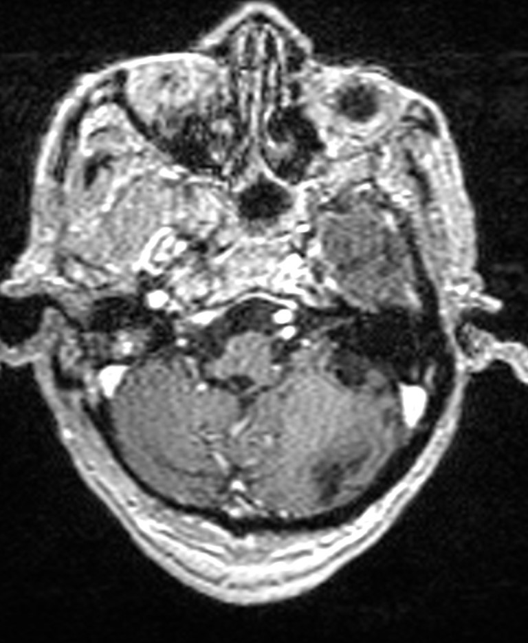 Brain abscess with dual rim sign (Radiopaedia 87566-103938 Axial T1 C+ 39).jpg