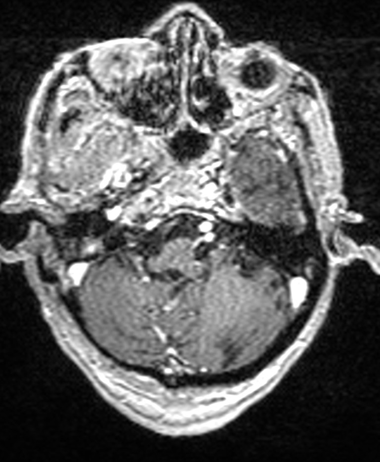 Brain abscess with dual rim sign (Radiopaedia 87566-103938 Axial T1 C+ 40).jpg