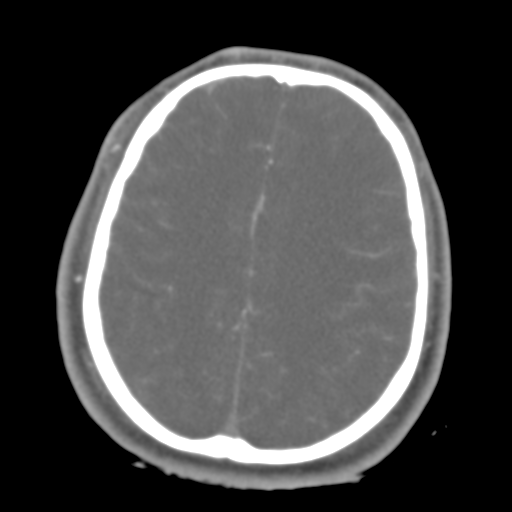 Brain contusions, internal carotid artery dissection and base of skull fracture (Radiopaedia 34089-35339 D 16).png