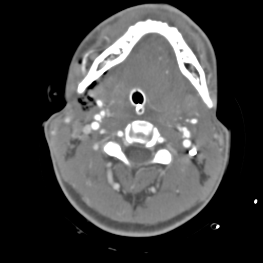 Brain contusions, internal carotid artery dissection and base of skull fracture (Radiopaedia 34089-35339 D 65).png