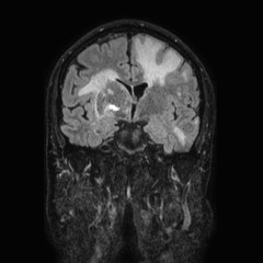 Brain metastases from lung cancer (Radiopaedia 83839-99028 Coronal FLAIR 36).jpg