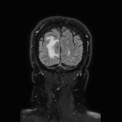 Brain metastases from lung cancer (Radiopaedia 83839-99028 Coronal FLAIR 76).jpg