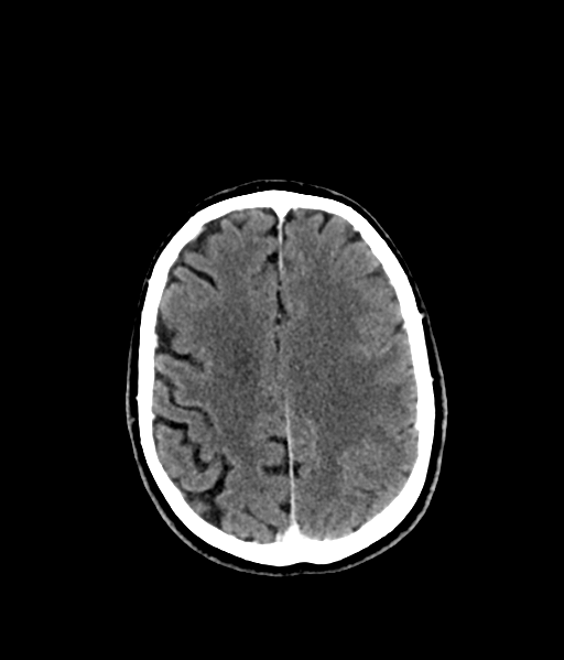 Brain metastasis (large cystic mass) (Radiopaedia 47497-52106 Axial C+ 43).png