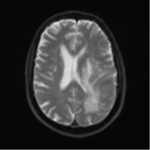 File:Brain metastasis (large cystic mass) (Radiopaedia 47497-52107 Axial DWI 17).png