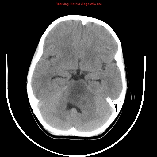 File:Brainstem glioma (Radiopaedia 9444-10123 non-contrast 7).jpg