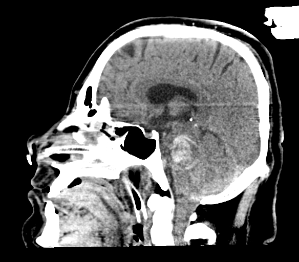 Brainstem hemorrhage (Radiopaedia 81294-94976 C 28).jpg